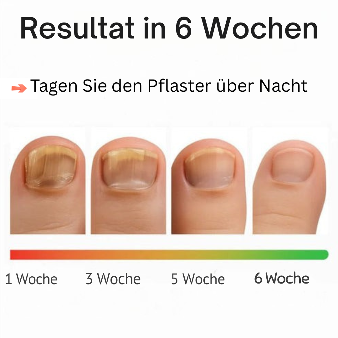 Nagelpflaster gegen Nagelpilz